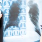 Understanding Lung Cancer ICD 10 Classification and Its Role in Clinical Trials 