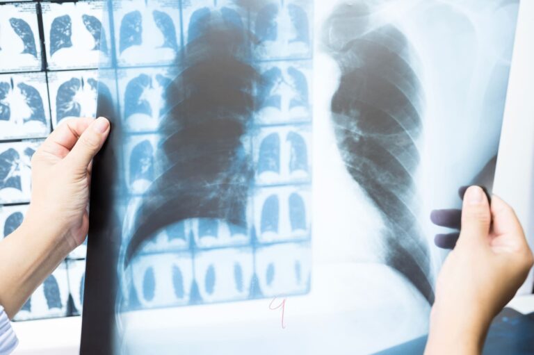 Understanding Lung Cancer ICD 10 Classification and Its Role in Clinical Trials 